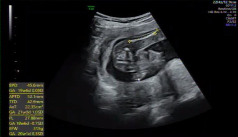 妊娠19週 5ヶ月 の記録 妊婦健診で何する 性別はわかった